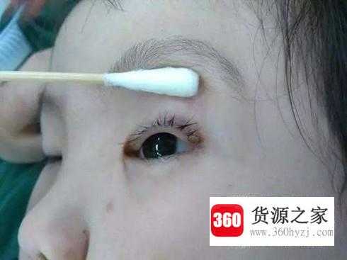 宝宝眼睛进异物时怎么护理？