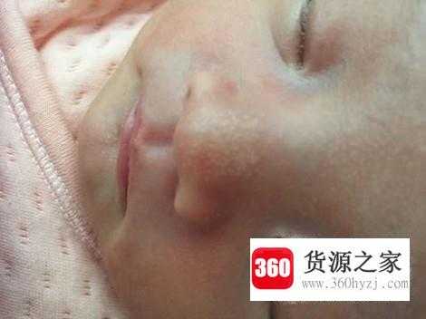 新生儿鼻子上为什么有白点