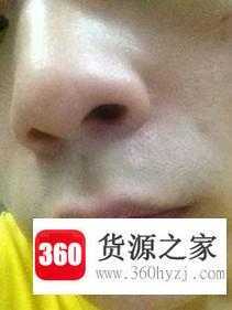 激光点痣的恢复过程