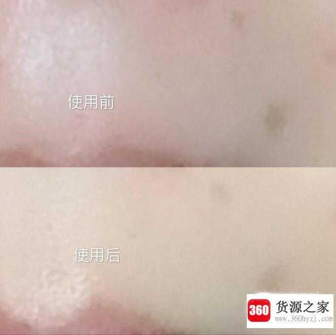 怎么加速淡化痘印？
