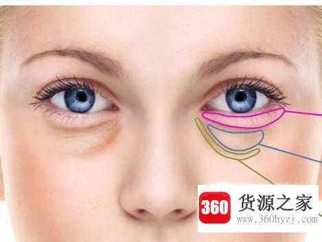 什么方法去眼袋最好