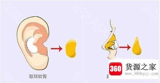 隆鼻手术的材料有哪些？