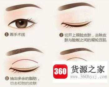单眼皮怎样变成双眼皮？