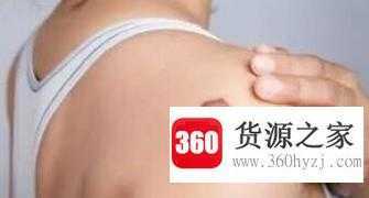 疤痕的类型有哪些？