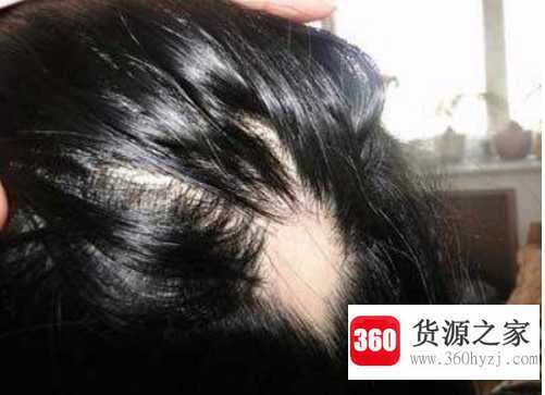 掉头发是什么原因