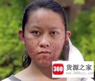 去除不同类型痘痘的方法