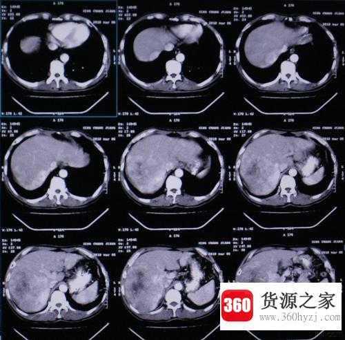 ct是什么意思