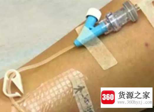 留置针是干嘛的