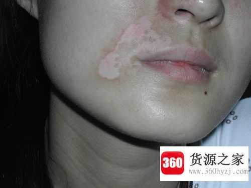 脸上长白斑是缺什么维生素