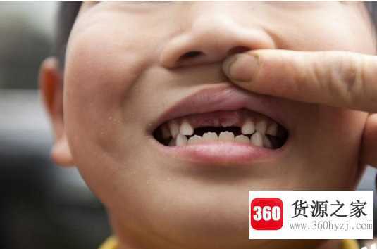 门牙有缝怎么办