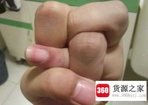 扳手指的危害有哪些