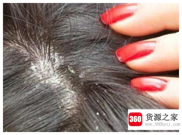 去除头上虱子的方法