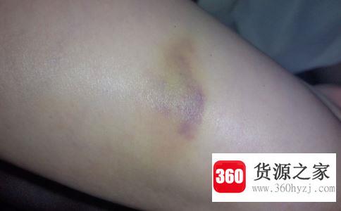 为什么磕碰后皮肤会出现淤青？
